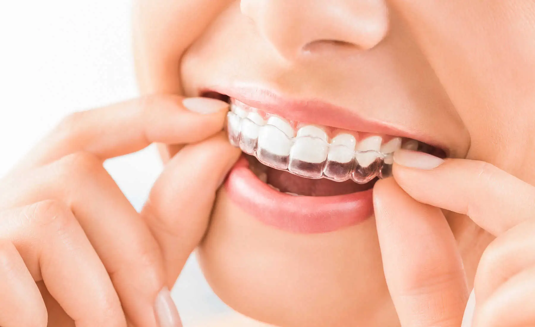 Clear Invisalign aligner